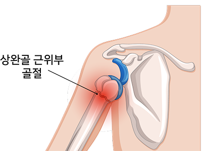 상완골 근위부 골절