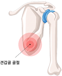 견갑골 골절
