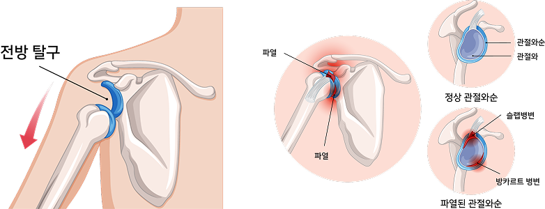탈구 및 관절와순 파열