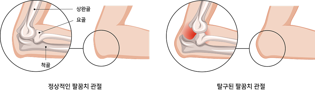 탈구 및 인대 파열