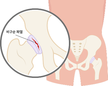 고관절 비구순 파열