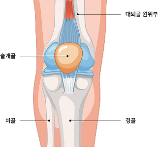 무릎 주변 골절