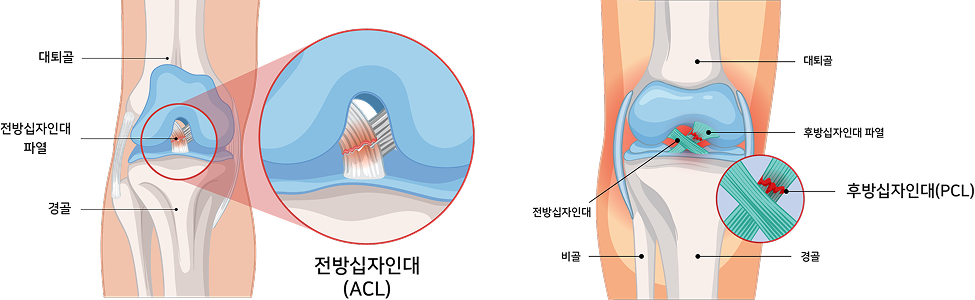 전방/후방 십자인대 파열