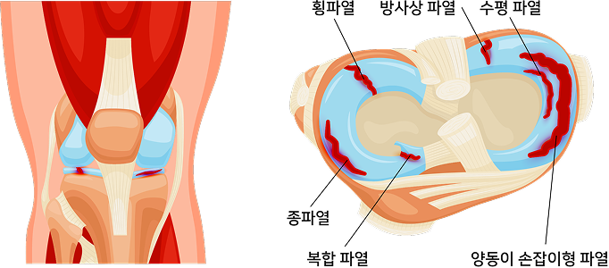 외상성 반월상 연골판 파열