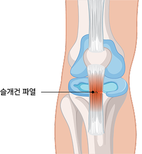 슬개건 파열