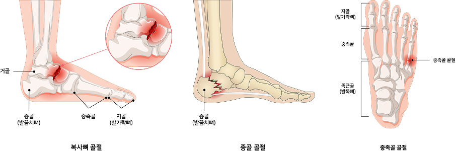발목 및 발 주변 골절